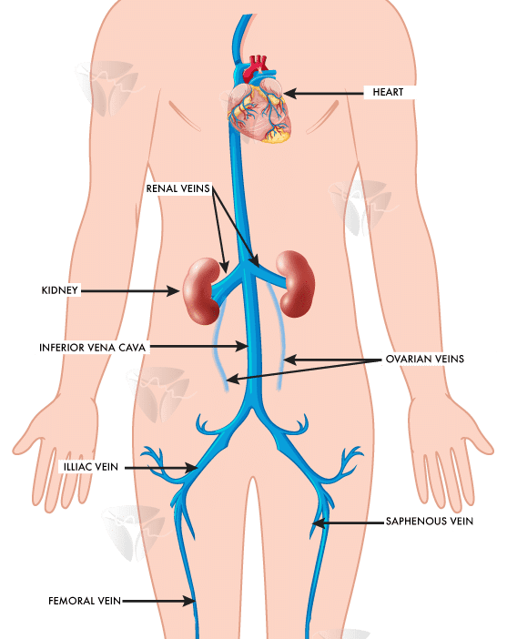 Varice perineale varice