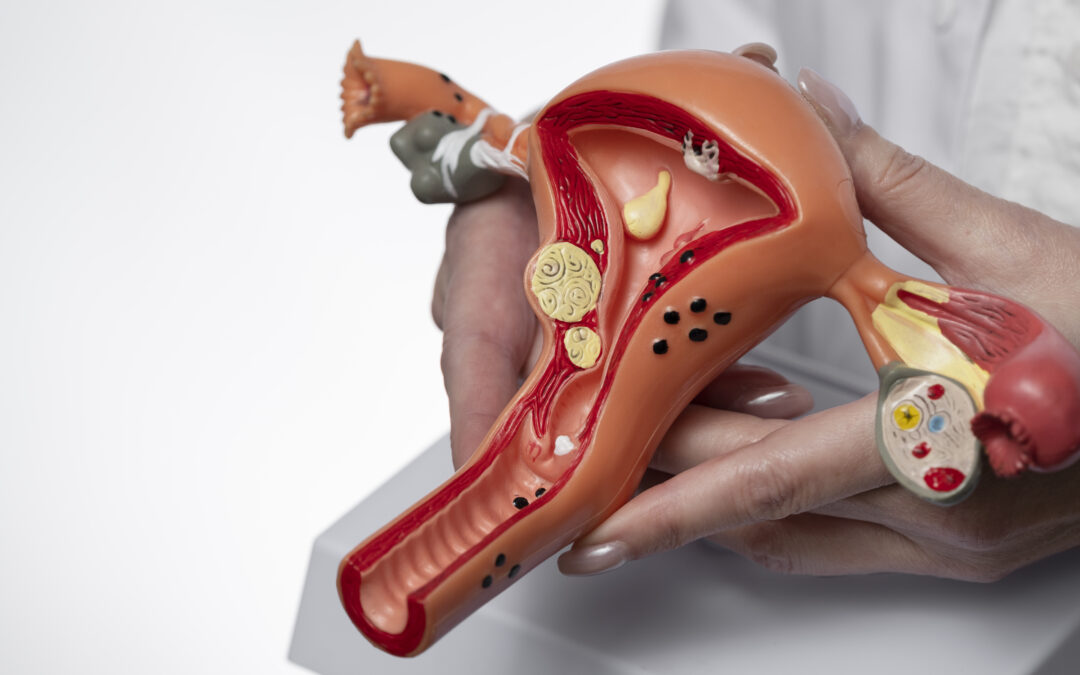Varicocèle et fertilité : la solution avec l’embolisation