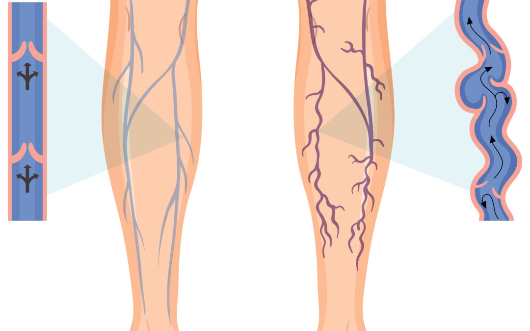 Varices vulvaires grossesse : Tous savoir