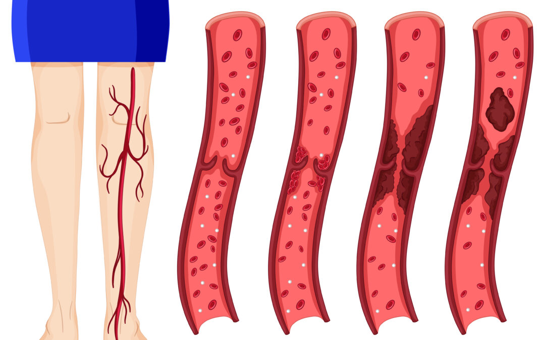 Varicocèle : traitement chirurgical et non chirurgical