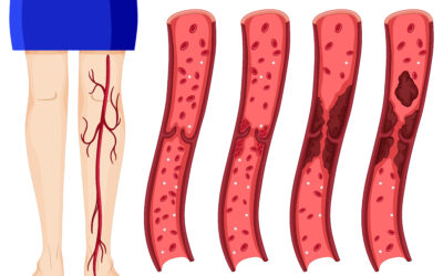 Varicocèle : traitement chirurgical et non chirurgical